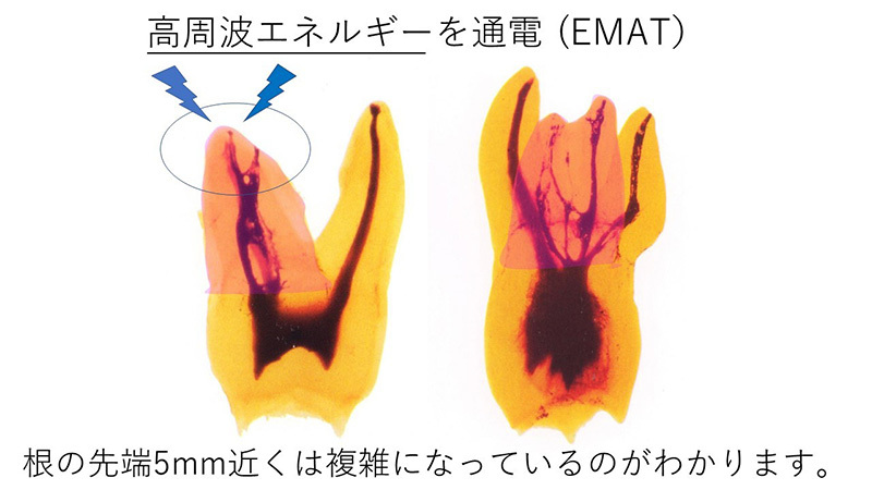 EMATを用いた根管治療・歯周病治療