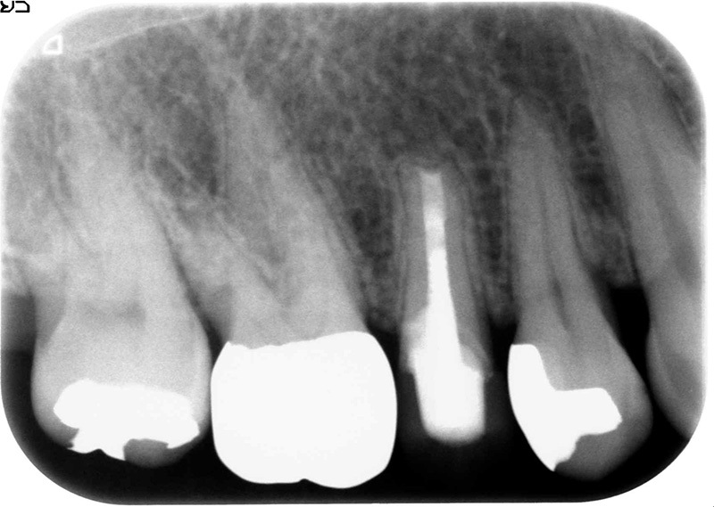 ④術後11ヵ月・・骨再生が進み歯根の周囲が健康になりました。